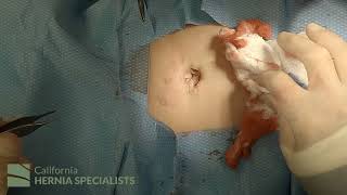 Open Umbilical Hernia Repair At California Hernia Specialists 4K