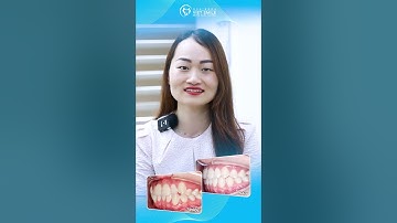 Thay đổi thế nào sau niềng răng invisalign #nhakhoavietsmile #invisalign #niengrang