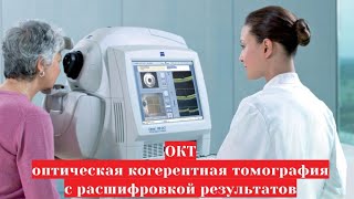 ОКТ - оптическая когерентная томография 👀 сетчатки и зрительного нерва с расшифровкой результатов