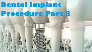 Dental Implant Procedure Part 3