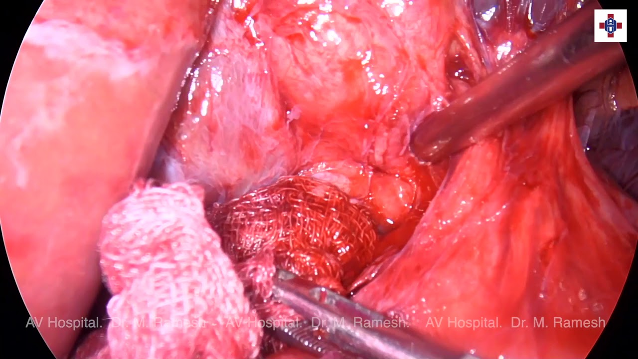 Completion cholecystectomy - ICG guided