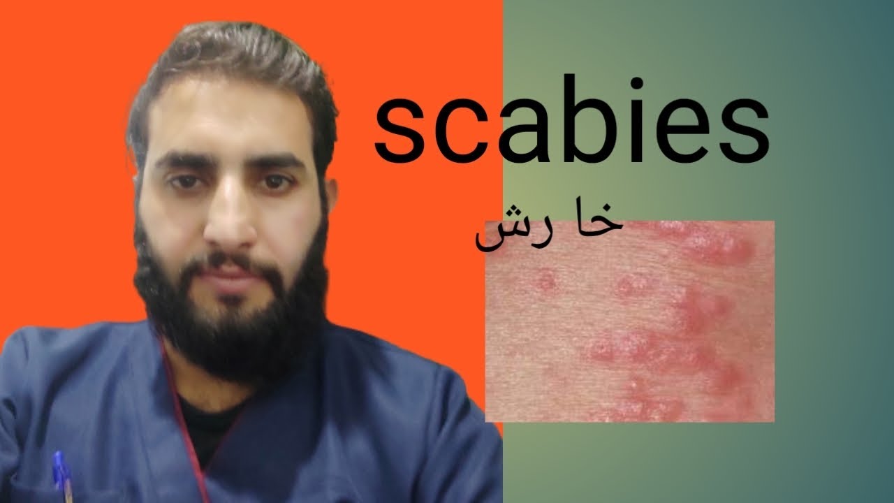 Scabies Treatment Scabies Rash Digitaldoctor738 YouTube scabies-treatment-scabies-rash-digitaldoctor738-youtube