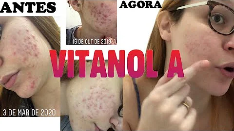 Como usar Vitanol A para acne?