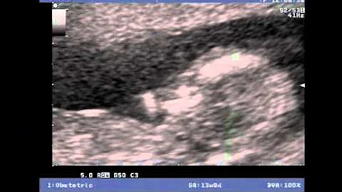 Ellis Tyson, 13 Weeks.