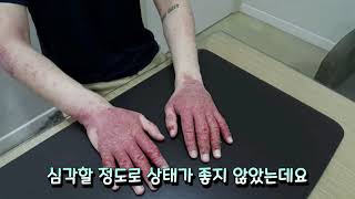 화폐상습진 치료과정