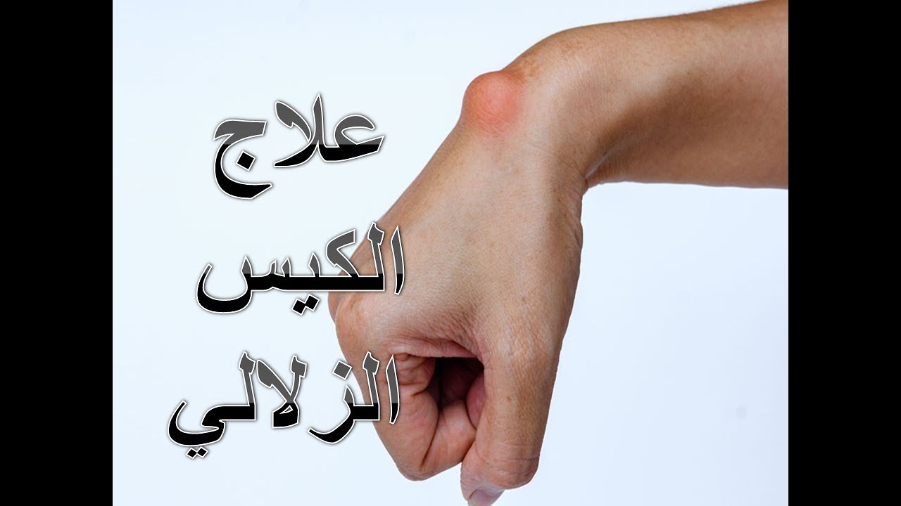 الكيس الزلالي | الكيس العقدي | علاج الكيس الزلالي