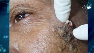 Comedão Comedone - Ep 01 Cravos Gigantes