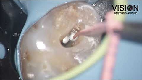 Easy Application of single syringe Bio C Sealer from Angelus