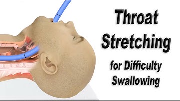 Esophageal Dilation or Throat Stretching for Difficulty Swallowing