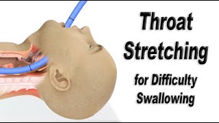 Esophageal Dilation or Throat Stretching for Difficulty Swallowing