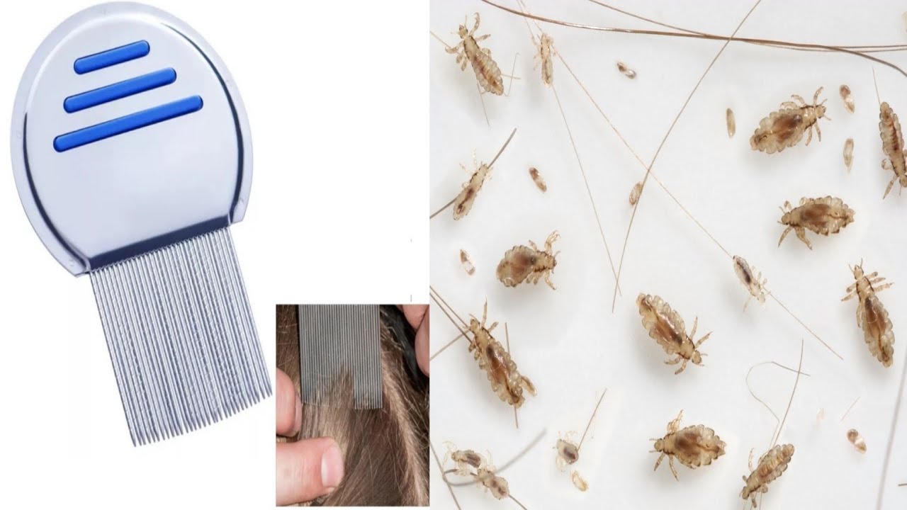 अब जुए एक ही बार में ख़त्म flipkart lice comb honest review🤮🤮 YouTube