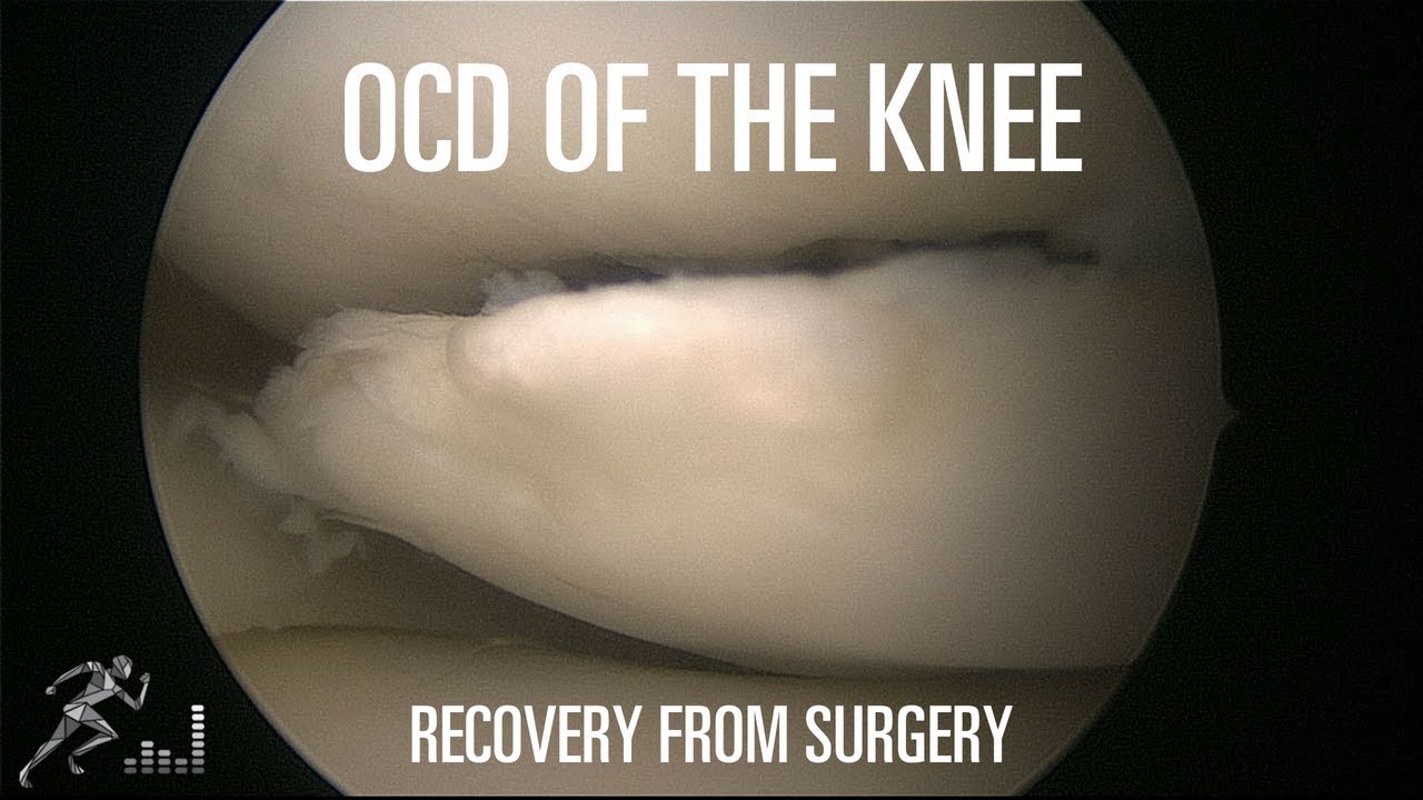 How Long Does It Take To Recover From Surgery For An Ocd Lesion Of The Knee Youtube