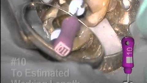 ProTaper Access & Shaping