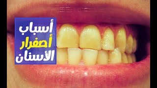 اسباب اصفرار الاسنان