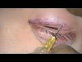 upper and lower eyelid blepharplasty + epicanthoplasty