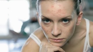 Угри, прыщи / акне: лучшие витамины и добавки для лечения проблемной кожи