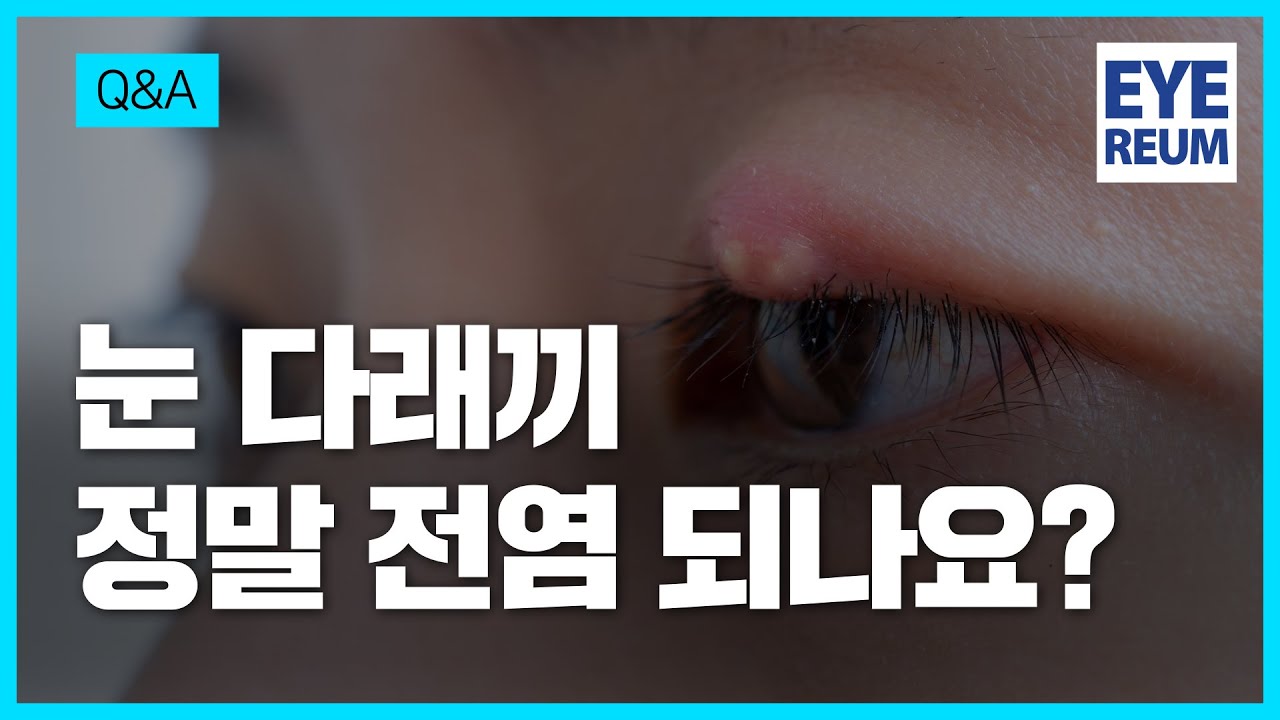 [艾利姆眼科診所] [艾利姆眼科] 麥粒腫會傳染嗎？