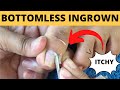 BOTTOMLESS INGROWN TOENAIL REMOVAL | Alma's Manicure and Pedicure Vlogs Philippines