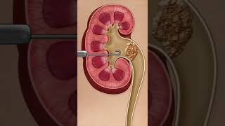 Kidney Stone Procedure - PreOp® Patient Education  #preop #patienteducation #medical  #shorts