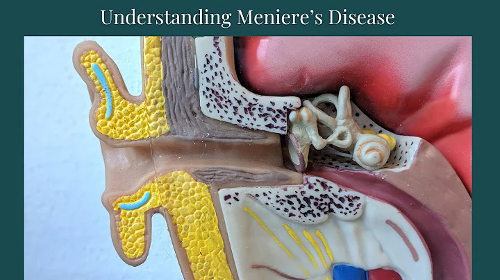 Meniere's Disease  Made Simple {Explained by a Physical Therapist}