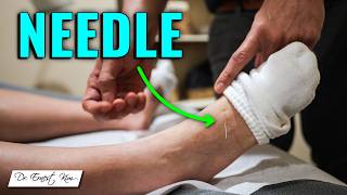 Scared of Needles? Watch a First Acupuncture Session