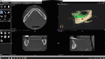 Demonstration of STL & Dicom mesh on CS8100 3D