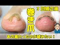 悩み続けた巻き爪がその日のうちに!【爪の間の角質が余計に痛み誘発】