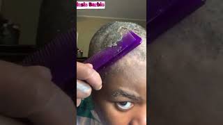 caspa grasa severa #tratamentocapilar #cuidadodelcabello #dandrufftreatment #scalpcare