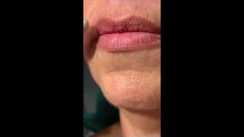 Lip Filler done naturally and beautifully