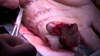 Operating On A Severed Hand - Bizarre ER