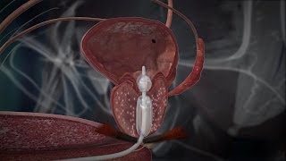 Improper Treatment of Prostate Cancer