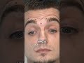 Why I draw cat ears on my Botox patients