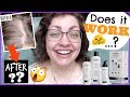 GOING BALD!? | 6 Months Using NIOXIN For Noticeably Thinning Hair