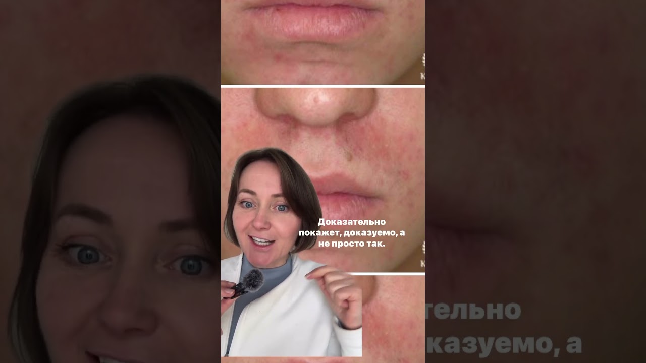 Покраснение вокруг носа и рта . Периоральный #дерматит . Причины