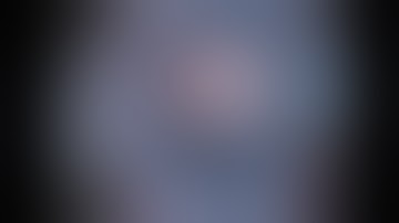 Posterior Polar Cataract, Posterior Capsule Rupture | Adv. IOL Fixation Techniques, by David Chang