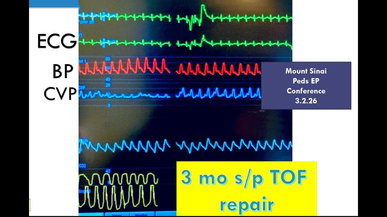 Педиатрическая электрофизиологическая конференция Маунт-Синай, 02.03.2026
