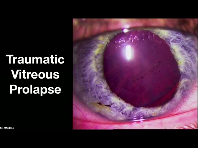 Traumatic glaucoma management