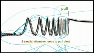 Concentric Medical (SNIS).mov Guide