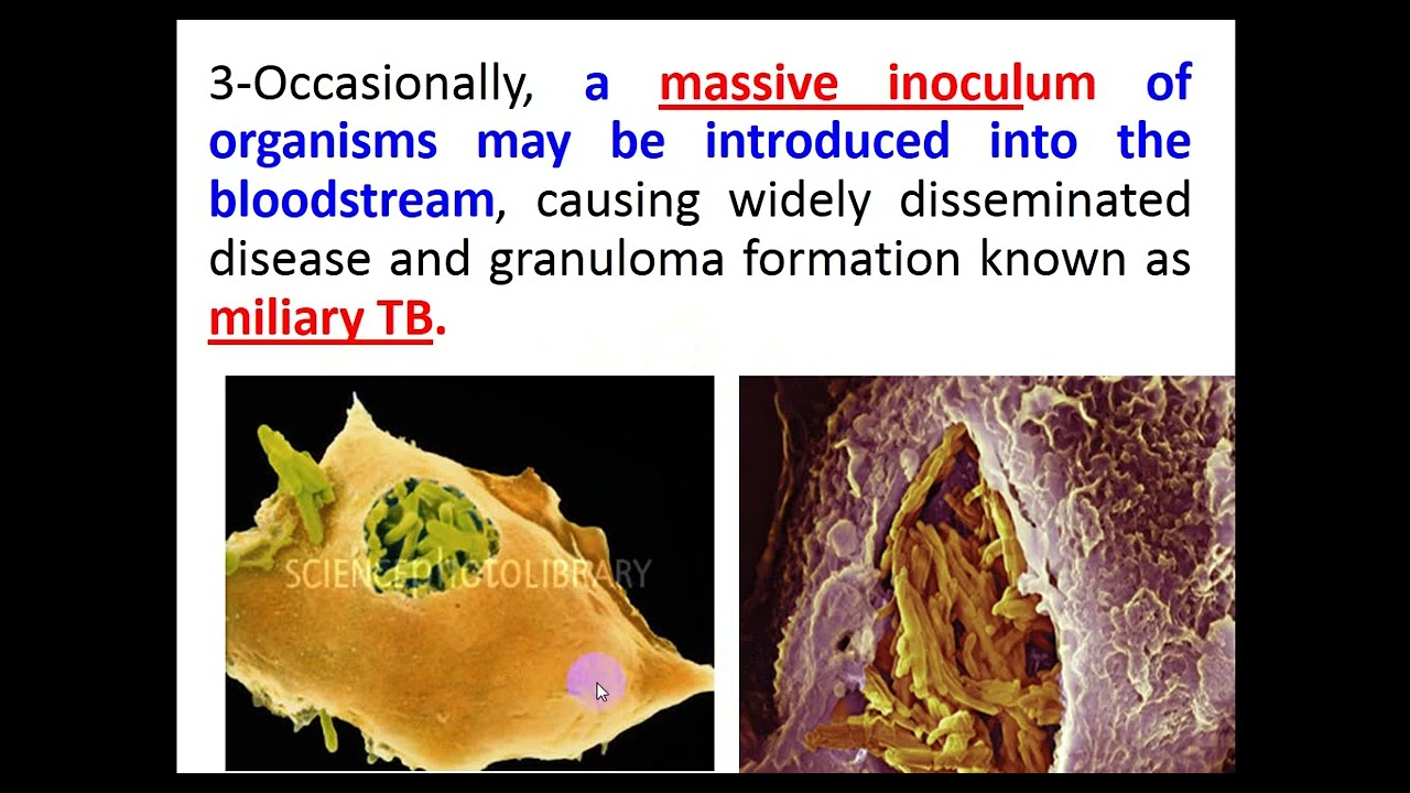 TB 2024 By Dr  Dheyaa Jabbar