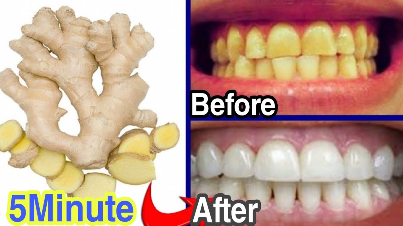 Get whiten teeth at home in 5 minute | Use Lemon & Ginger | how to get ...