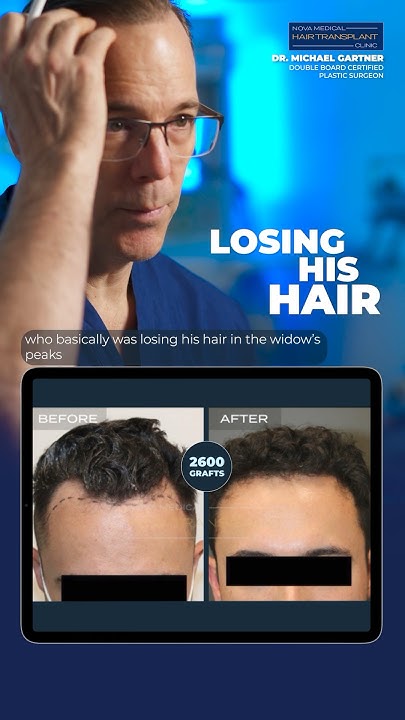 🌱Dr. Gartner Unveils a Remarkable Hair Transplant Case / 