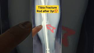 टिबिया फ्रैक्चर के 3️⃣ साल बाद🔥| 3 yrs. follow up |#tibia #tibiafracture #fracturerecovery #fracture