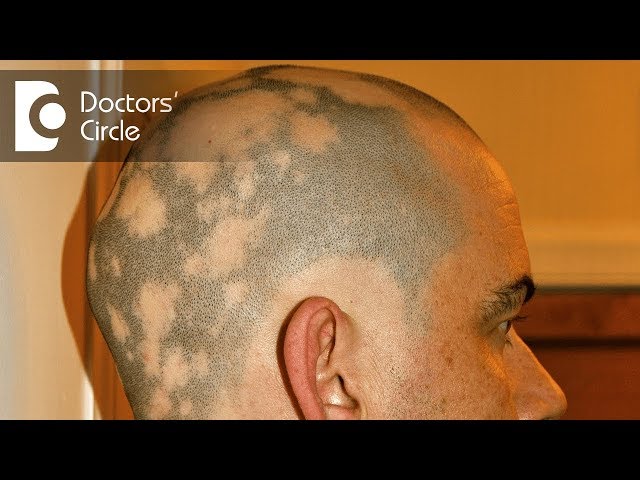 glutathione alopecia areata FDA approving medicine to treat patients suffering with severe Alopecia Before & After: Treating