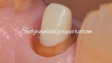 Subgingival preparation〜provisional restoration