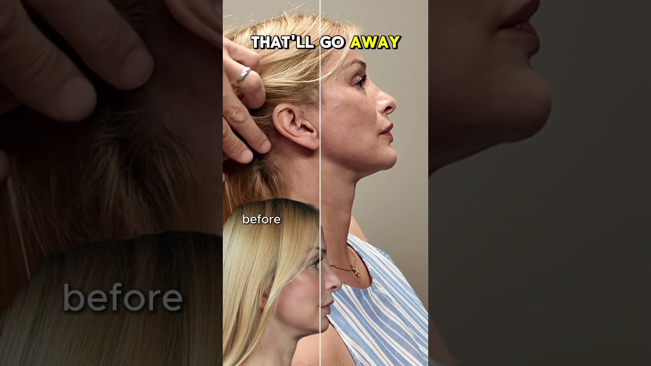 2 Months After a Deep Plane Facelift & Neck Lift | Stunning Natural Results