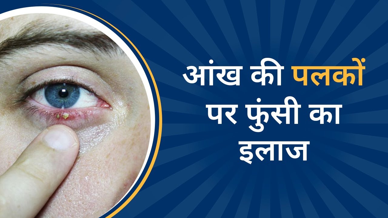 How to Get Rid of a Stye Overnight Stye in Eye Treatment आँख के
