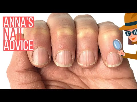 RIDGY NAILS? THE ONLY SOLUTION. [ANNA&rsquo;S NAIL ADVICE]