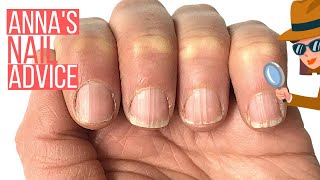 RIDGY NAILS? THE COSMETIC SOLUTION. [ANNA'S NAIL ADVICE]