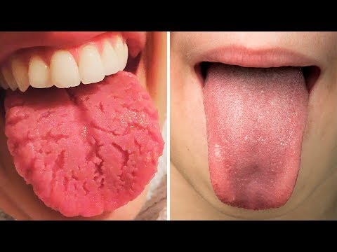 What Your Tongue Says About Your Health