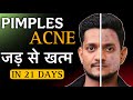 Facial Yoga to Treat Acne, Scars, and Pigmentation | Yoga for Skin Problems #faceyoga #acne